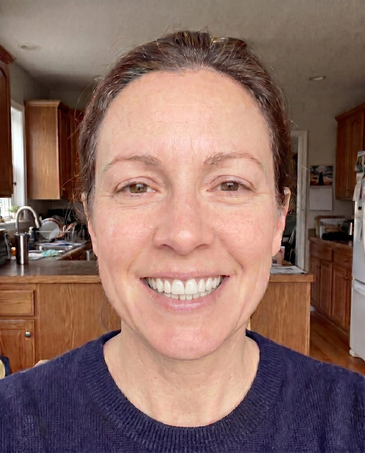 Veneers — High Aesthetic